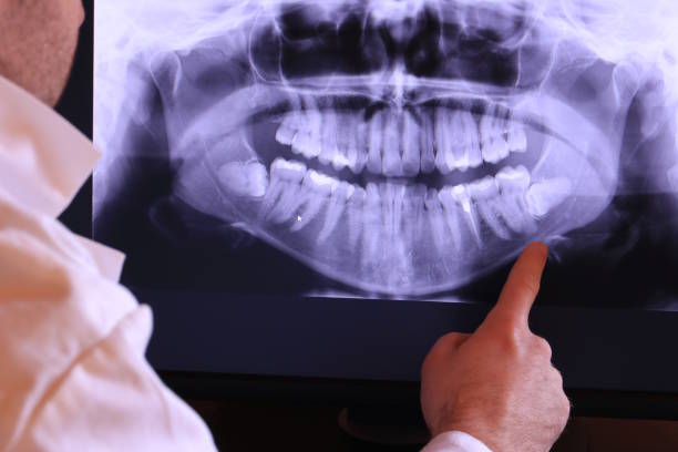 Best Emergency Wisdom Teeth Removal in Brooks, KY